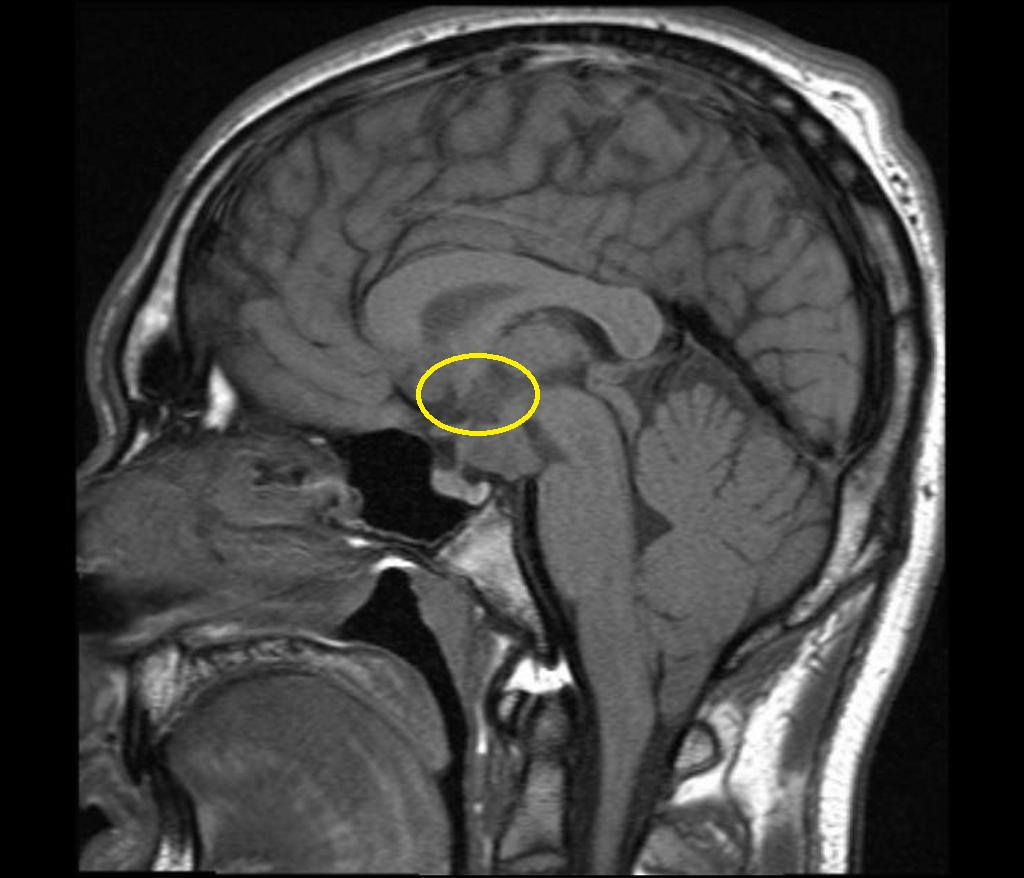 Hypothalamic lesion - Case courtesy of A.Prof Frank Gaillard, <a href="https://radiopaedia.org/">Radiopaedia.org</a>. From the case <a href="https://radiopaedia.org/cases/16890">rID: 16890</a>