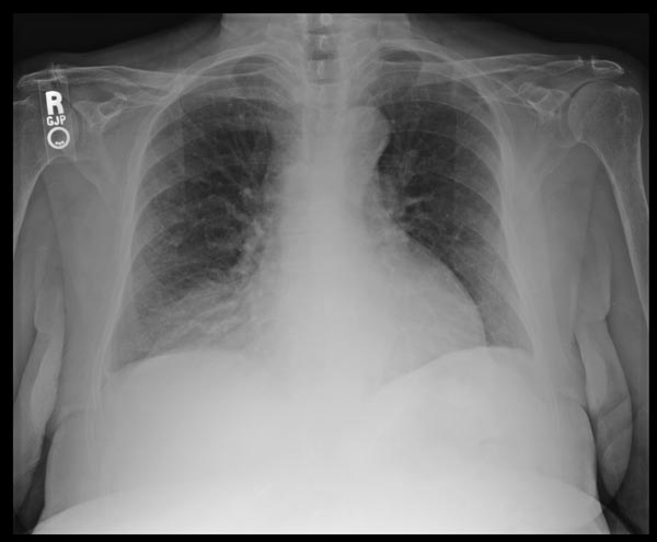 Mass adjacent to heart seen on chest x-ray