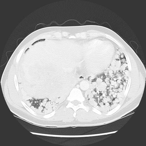 Pulmonary metastases3.jpg