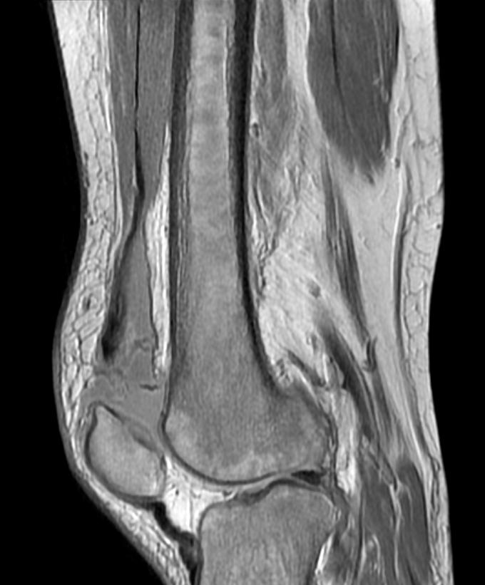 File:Quadriceps tendon rupture 002.jpg