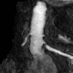 File:Renal artery stenosis 020.jpg