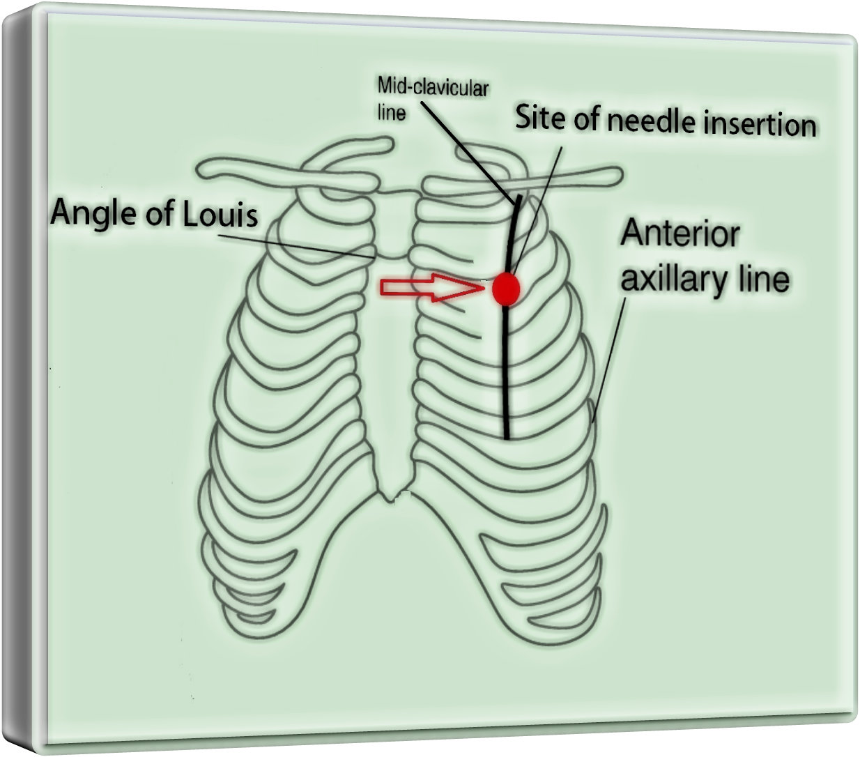 File:Site of needle insertion - 11.jpg