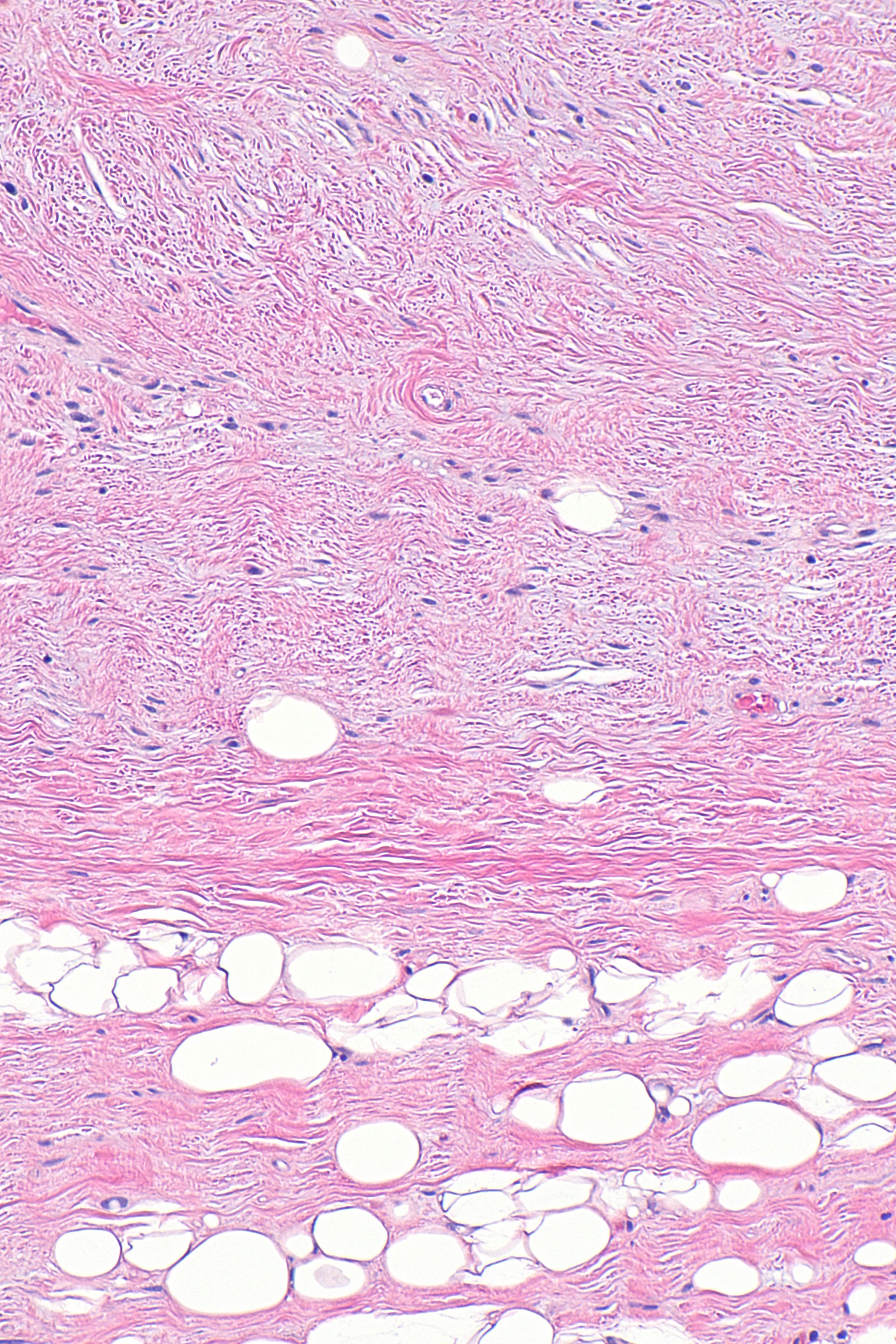 File:Spindle cell lipoma -- intermed mag.jpg