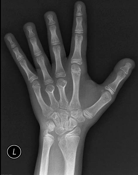 Turners syndrome hand