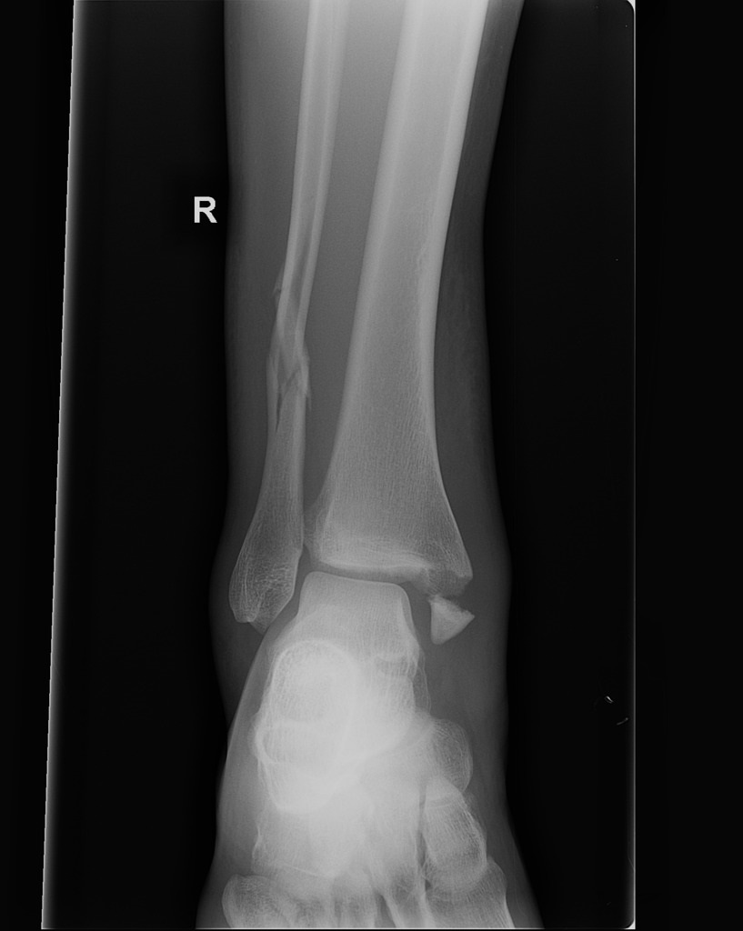 Ankle-fractures-pronation-external-rotation-mechanism