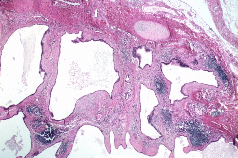 Lower Respiratory Tract: Bronchogenic cyst; There is a multiloculated cyst lined by bronchiolar epithelium. A small island of cartilage is present at the upper right.