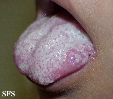 Candidiasis. Adapted from Dermatology Atlas.[62]
