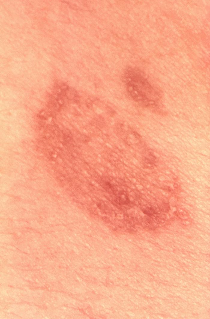Lesions that were diagnosed as ringworm, attributed to a dermatophytic fungal organism, Trichophyton verrucosum. From Public Health Image Library (PHIL). [1]
