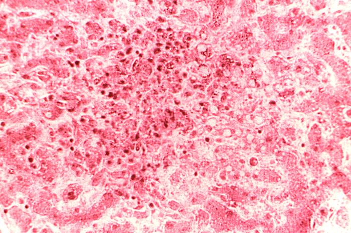 Cytoarchitectural changes found in a liver tissue specimen extracted from a Congo/Crimean hemorrhagic fever patient (280X mag). From Public Health Image Library (PHIL). [12]
