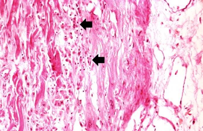 This is a high-power photomicrograph of a different region of this healed MI. Note the chronic inflammatory reaction (arrows) in this region suggesting that there had been ischemic injury to this area within the last several weeks to months.