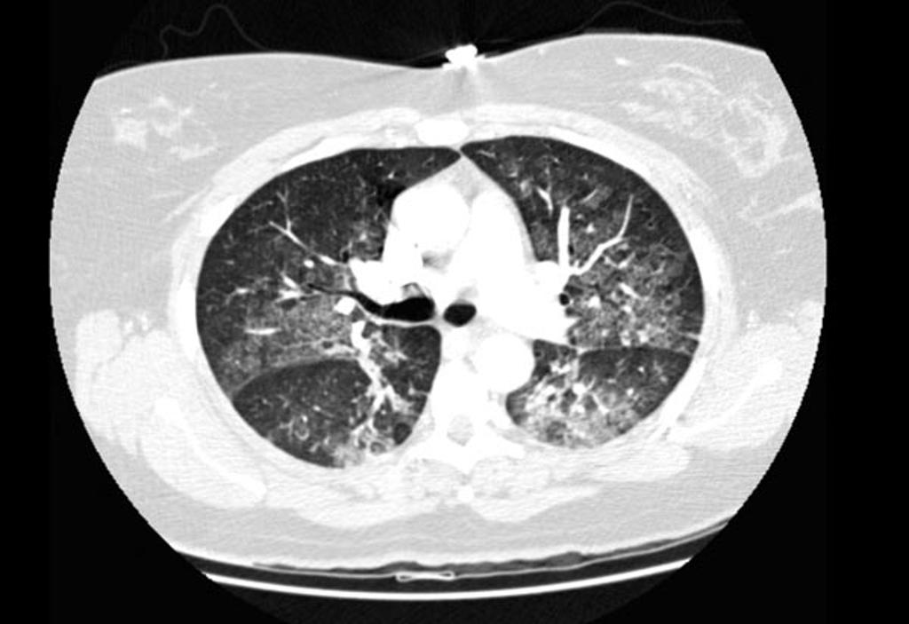 File:Pulmonary-oedema-1.jpg