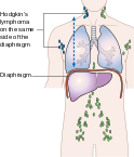 File:124px-Diagram showing stage 2 Hodgkin's lymphoma CRUK 208.svg.png