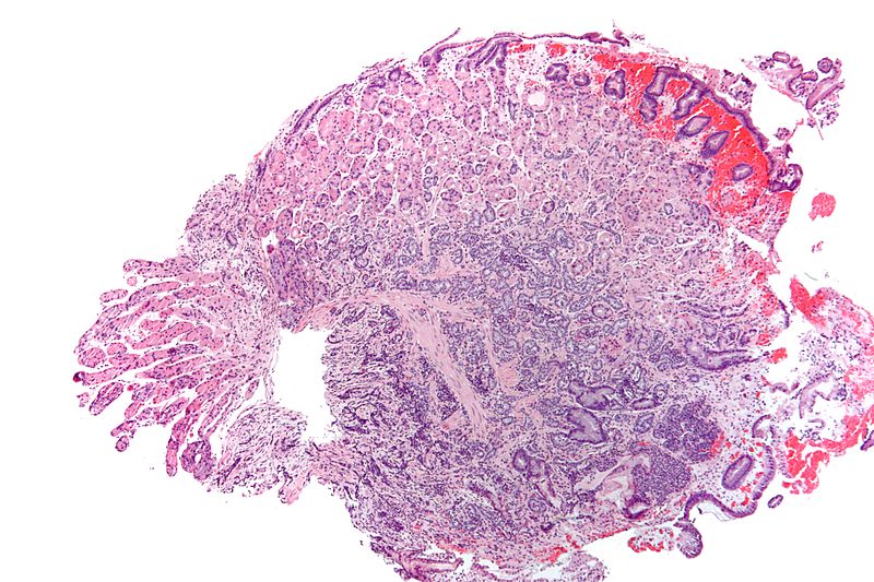File:800px-Gastric neuroendocrine tumour - low mag.jpg
