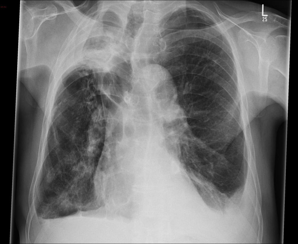 Chest X-ray that demonstrate a densitiy in the right upper zone with clear evidence of volume loss (the trachea and mediastinum are pulled towards the right, and the hilum is elevated)
