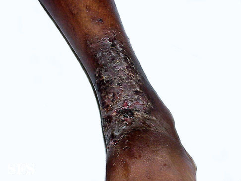 File:Eczema microbic02.jpg