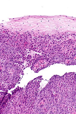 File:Esophageal squamous cell carcinoma.jpg