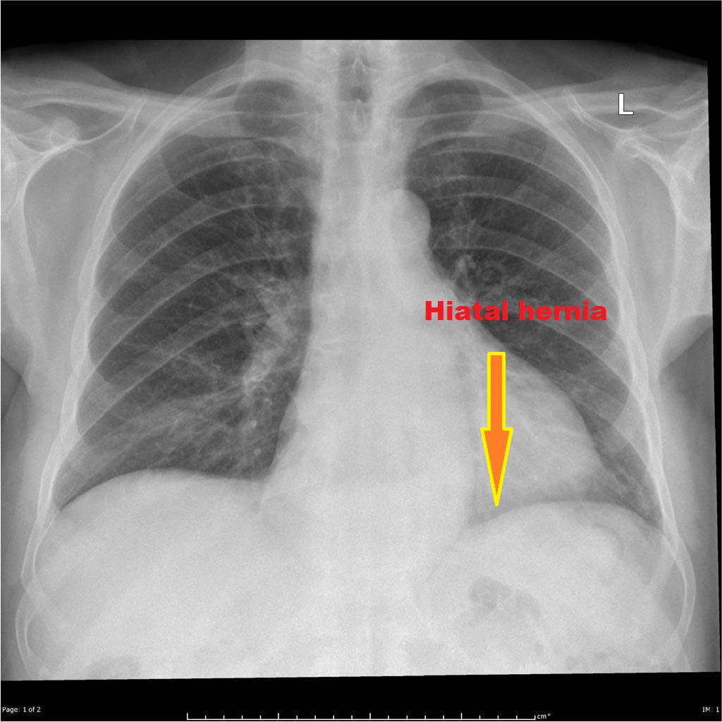 Ches X-ray: A Hiatal hernia- Frontal view Air-fluid level behind the heart on the lateral radiograph. Source:Case courtesy of Dr Andrew Lawson, Radiopaedia.org, rID: 25499[3]