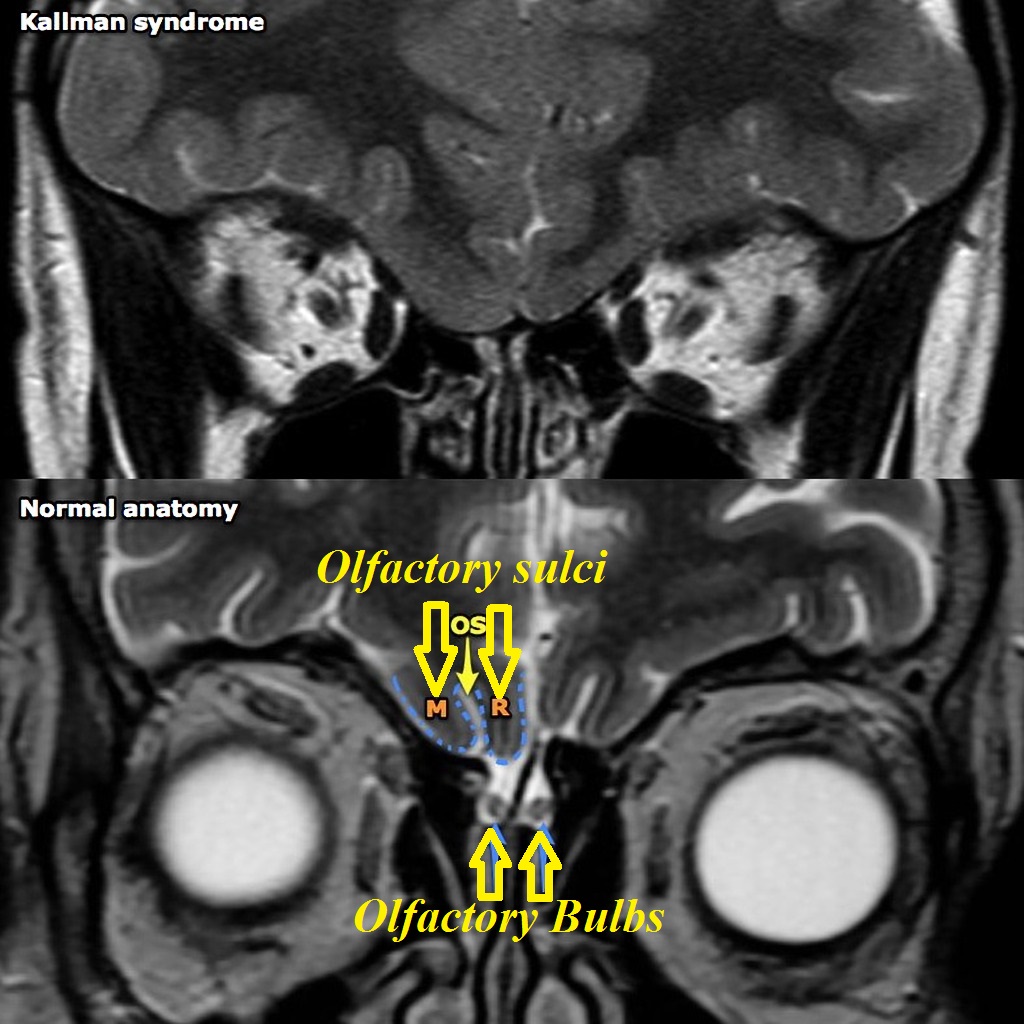 Kallman syndrome difference with normal brain - Case courtesy of A.Prof Frank Gaillard[1]