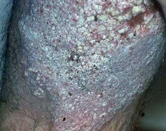 File:Lupus vulgaris case1.jpg