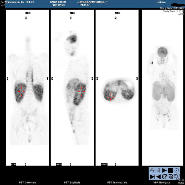 File:Angioimmunoblastic T-cell lymphoma PET Scan.jpg