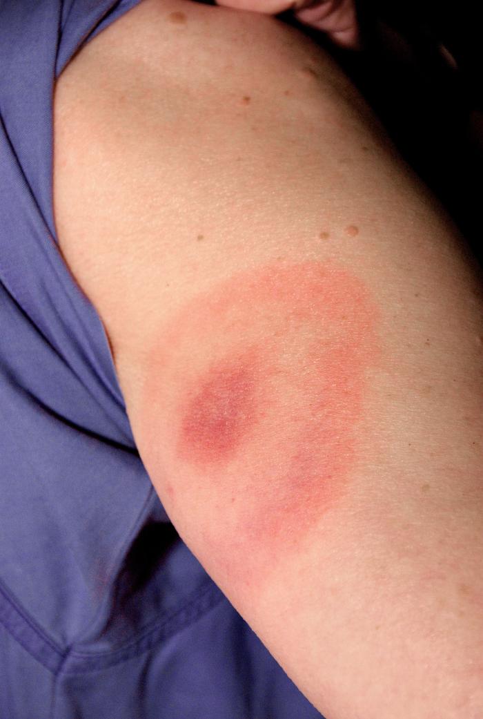 This 2007 photograph depicts the pathognomonic erythematous rash in the pattern of a “bull’s-eye”, which manifested at the site of a tick bite on this Maryland woman’s posterior right upper arm, who’d subsequently contracted Lyme disease. From Public Health Image Library (PHIL). [1]