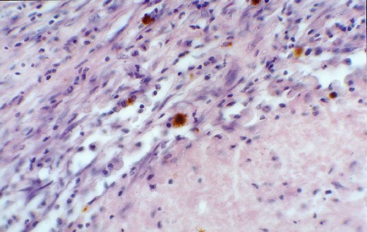 Hemosiderin laden macrophages in the more fibrous areas (junction of infarction)