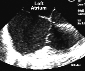 In this echocardiogram, a large secundum ASD is seen in the middle of the atrial septal wall.