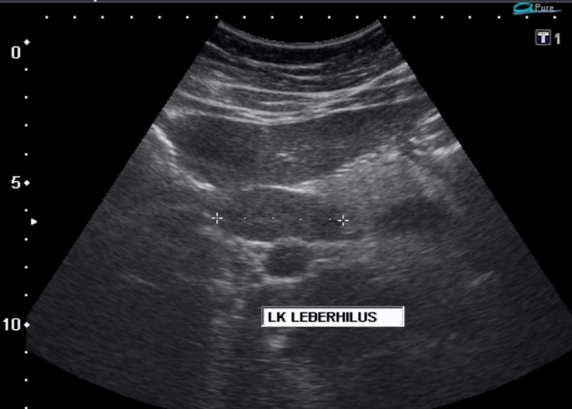 File:Splenic marginal zone lymphoma ultrasound oblique.jpeg