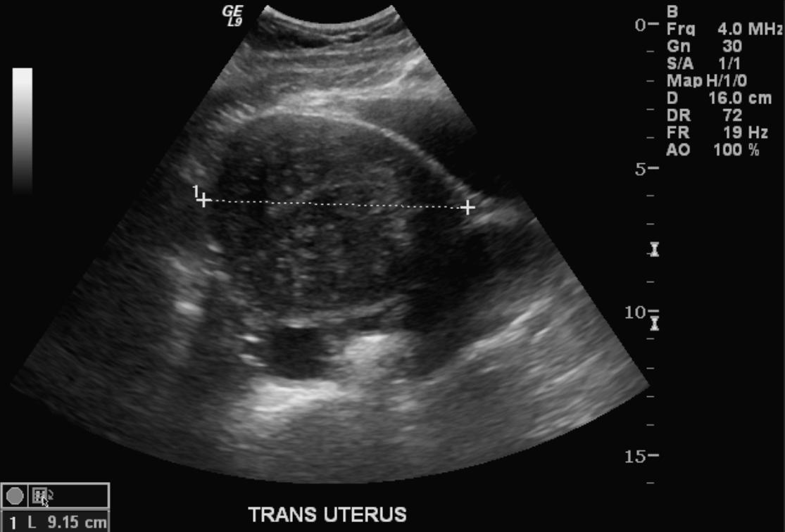 File:Adenomyosis ultrasound 103.jpg