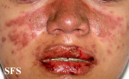 Lupus erythematosus-systemic. Adapted from Dermatology Atlas.[26]