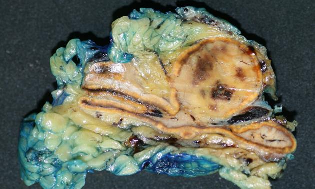Pheochromocytoma, Image courtesy of Dr Frank Gaillard[9]