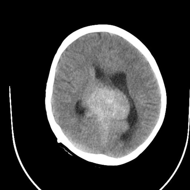 Axial brain CT image demonstrating a large hyperdense lobulated mass in the pineal region with peripheral foci of calcification and associated hydrocephalus. A VP shunt has recently been inserted (note the small amount of pneumocephalus). Hyperdense material is observed coating the frontal horns of the lateral ventricle and filling the floor of the third ventricle.[17]