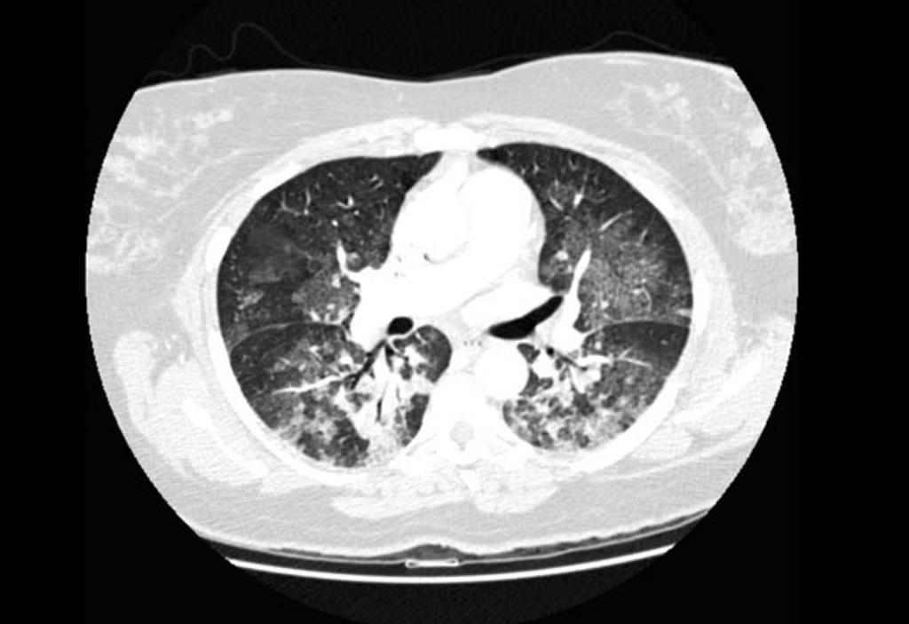 File:Pulmonary-oedema-2.jpg