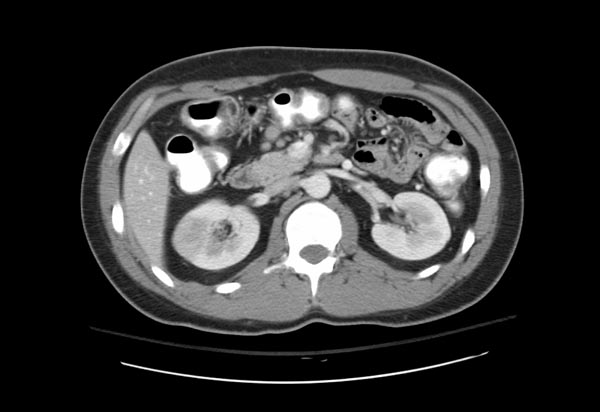 CT demonstrates a right renal infarction patient#2 Image courtesy of RadsWiki and copylefted