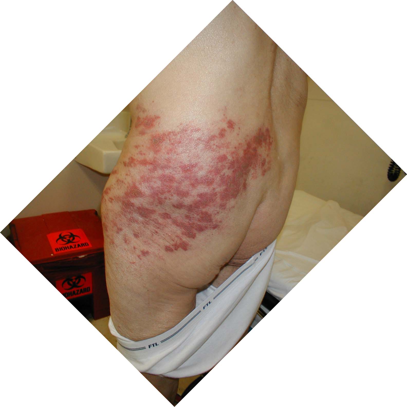 Herpes Zoster: Dermatomally distributed vesicles, many of which have coalesced, in patient with HZV infection.