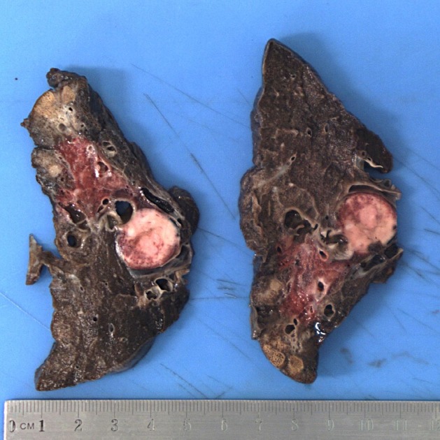 File:Bronchial carcinoid tumor Gross pathology.jpeg