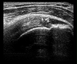 File:Dx us calcified subscapularis tendon.jpg