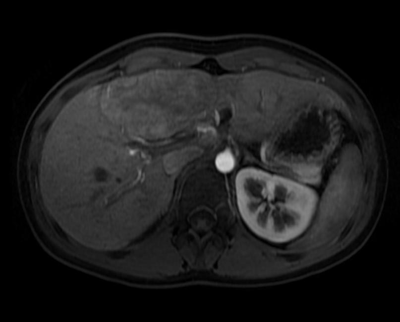 T1 fat sat arterial: A patient with multiple adenoma