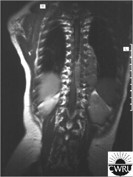 File:Spinal cord compression.jpg