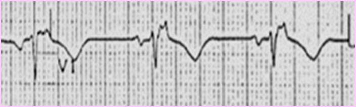 Arrhythmogenic right ventricular dysplasia - Inverted T waves.jpg