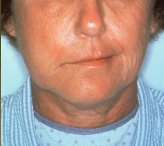 Facial palsy caused by an infection by the bacterial spirochete Borrelia burgdorferi, and was subsequently diagnosed with Lyme disease. From Public Health Image Library (PHIL). [14]