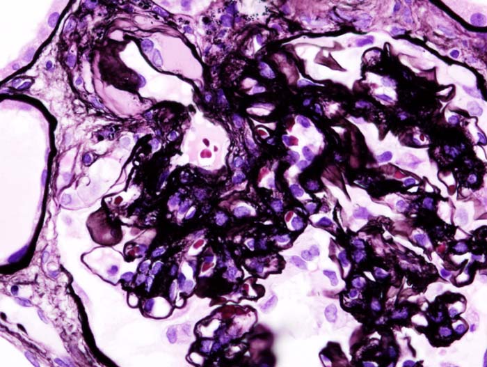 Histopathological image of diabetic glomerulosclerosis with nephrotic syndrome. PAM stain.
