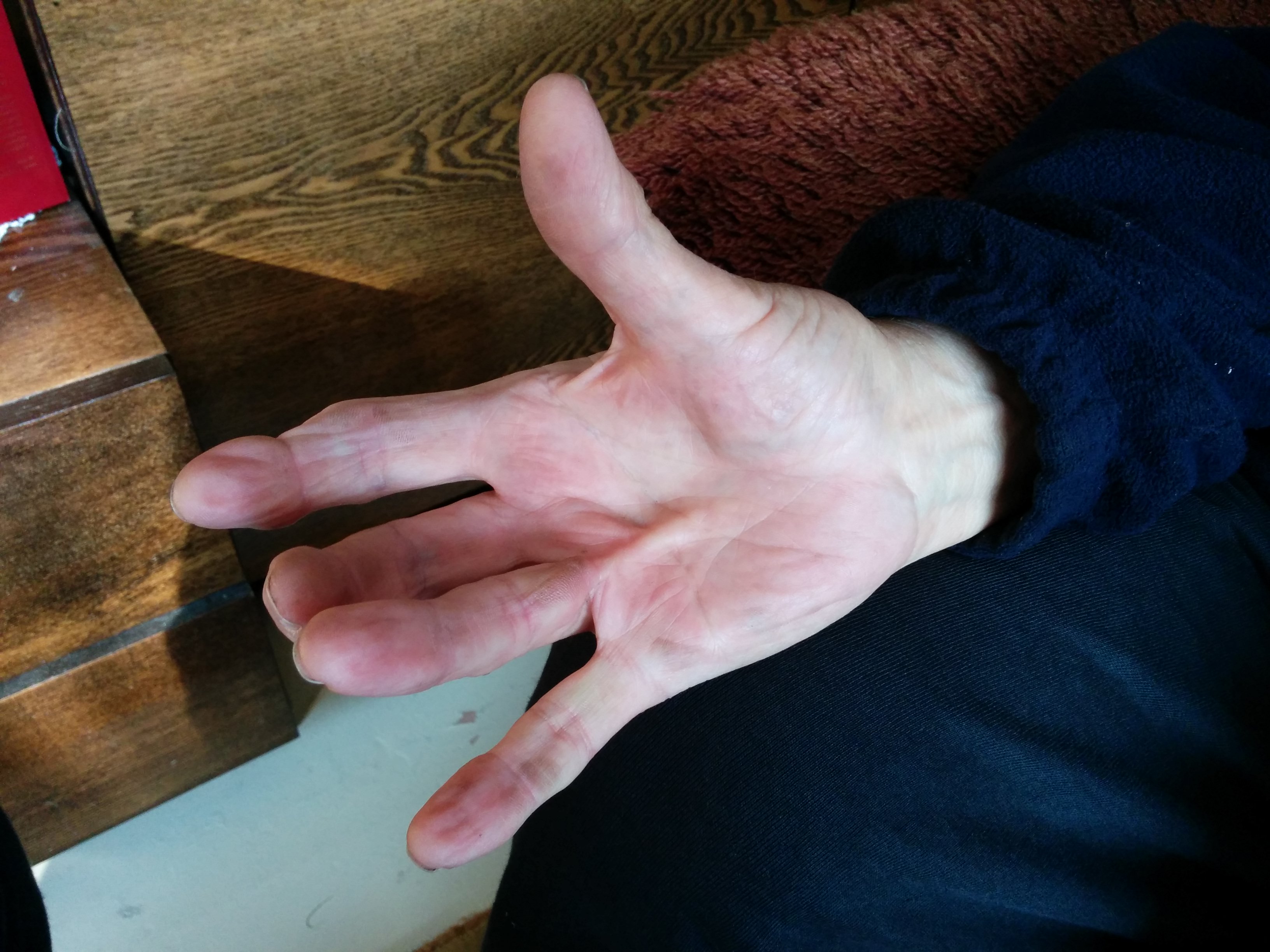 File:Dupuytren´s Contracture on the ring finger.jpg