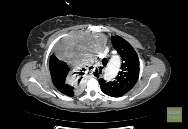 File:Fibrous-tumor-pleura-003.jpg