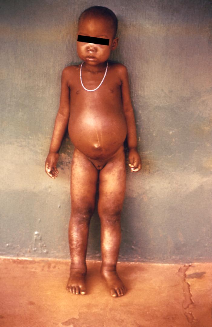 This child with hookworm shows visible signs of edema, and was diagnosed with anemia as well. From Public Health Image Library (PHIL). [1]