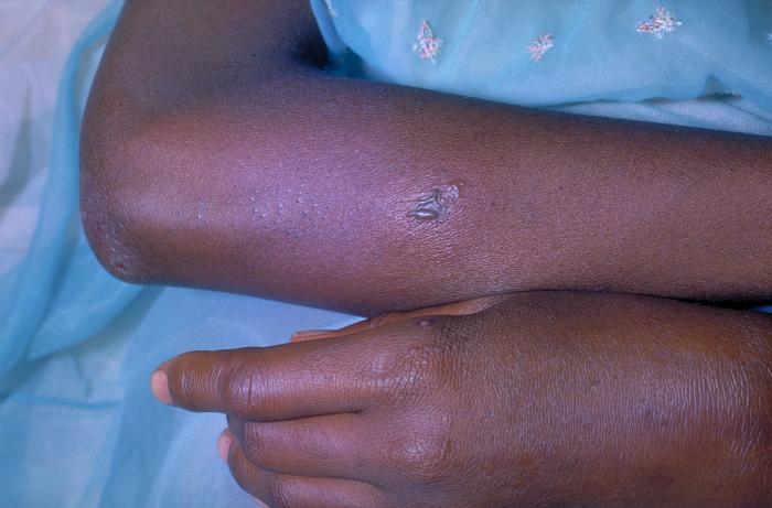 Note the gonococcal lesion on the skin of the left arm due to the bacterium Neisseria gonorrhoeae.N. gonorrhoeae, a gram-negative diplococcus, is the causative agent for Gonorrhea. Though these bacteria can infect the genital tract, the mouth, and the rectum, they can become disseminated throughout a person’s bloodstream.