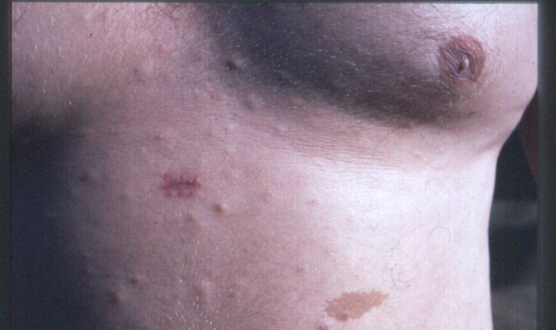 Patient with multiple small cutaneous neurofibromas and a 'café au lait spot' (bottom of photo, to the right of centre). A biopsy has been taken of one of the lesions