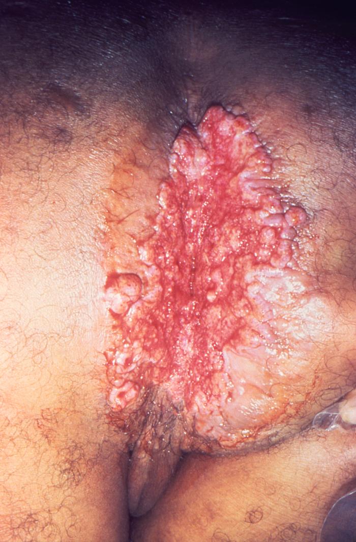 This was a very large erosive cutaneous lesion in the perineal region of this patient, which had been diagnosed as Donovanosis, otherwise known as granuloma inguinale. From Public Health Image Library (PHIL). [2]