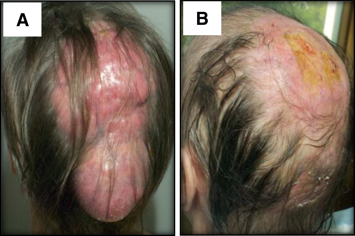 File:Primary cutaneous follicle centre lymphoma images.jpg
