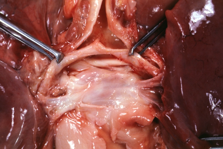 Pulmonary vein stenosis: Gross, natural color, unopened veins and atrium dorsal view